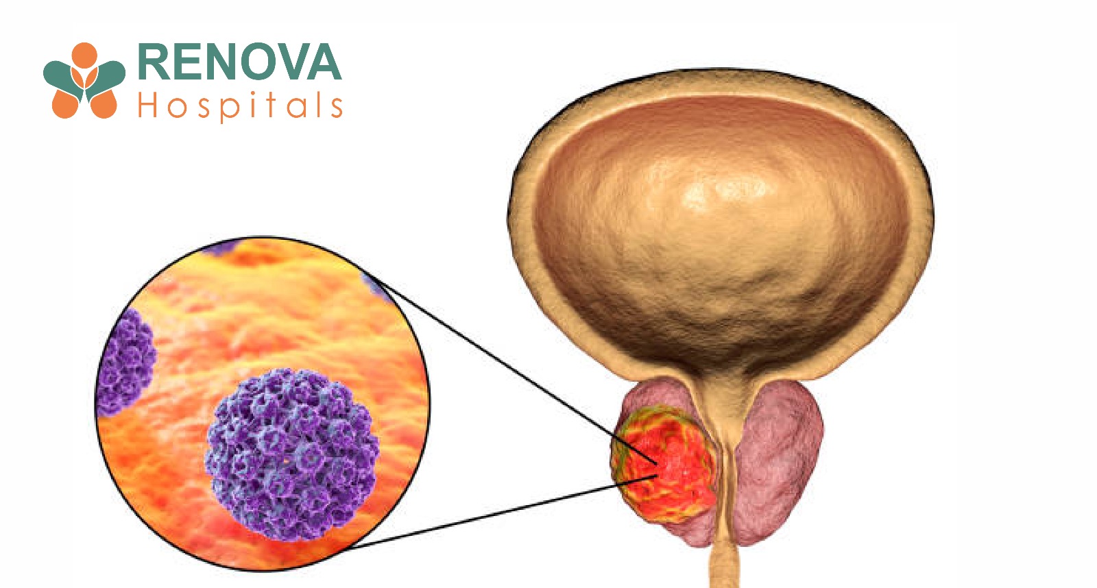 Prostate Cancer: Symptoms, Stages, Survival Rate & Treatment in India