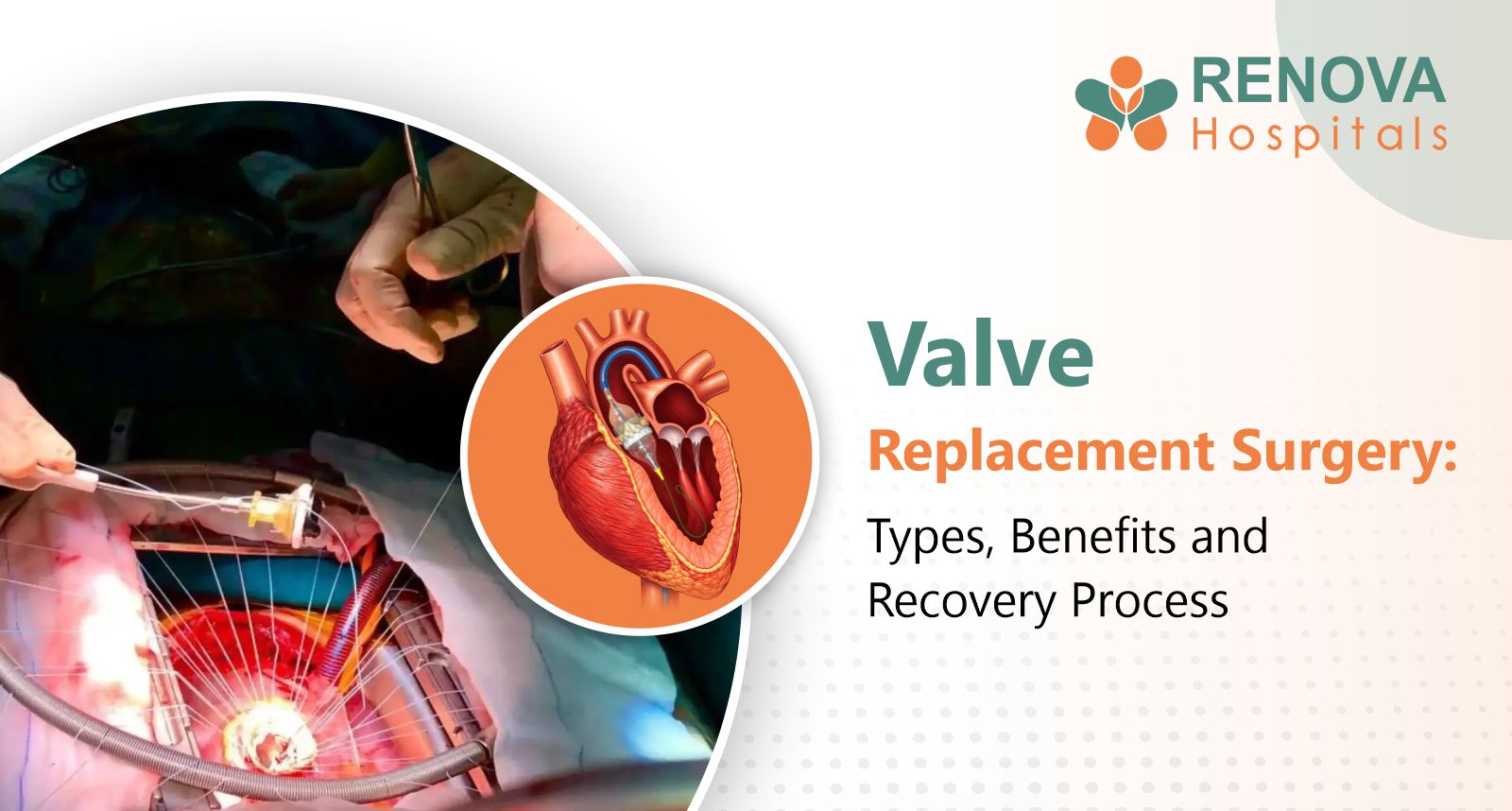 Types of heart valve replacement surgery and recovery process