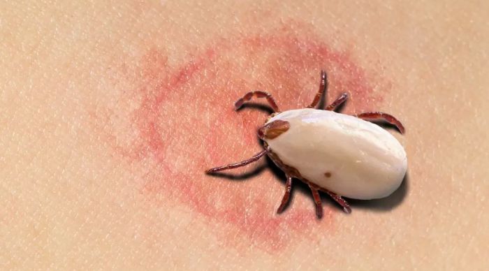 Babesiosis infection awareness, tick-borne disease
