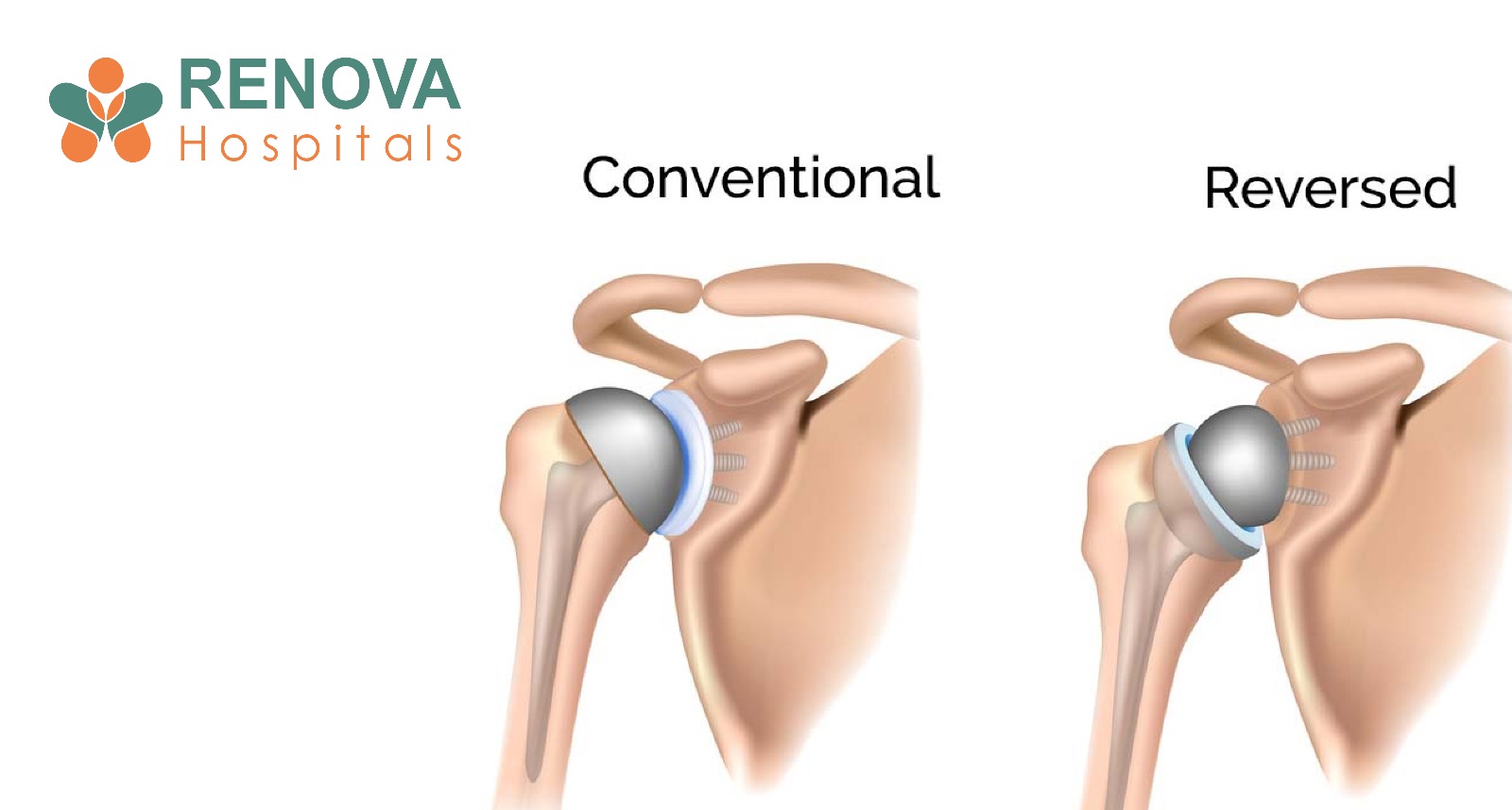 Reverse Shoulder Replacement Restores Mobility and Relieves Severe Shoulder Pain