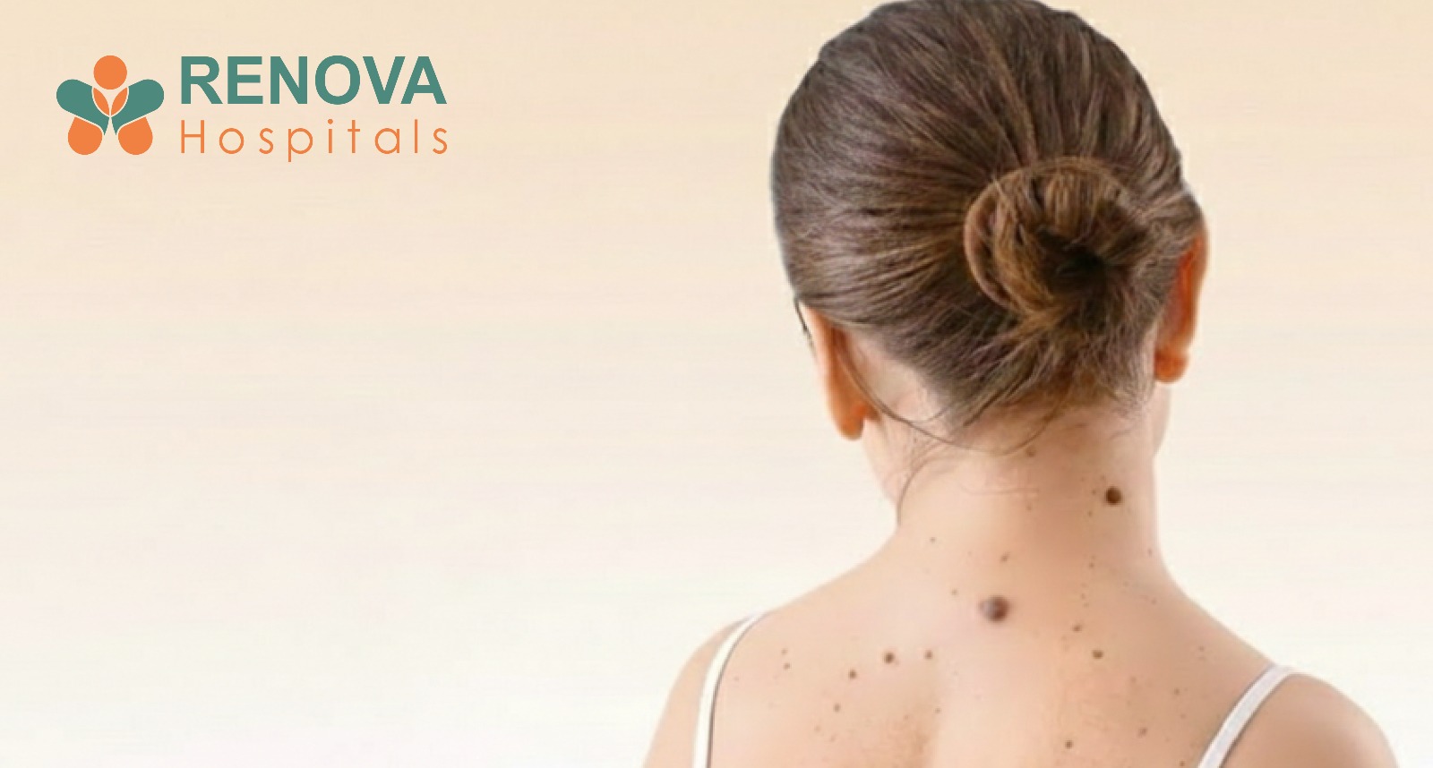 A woman showing moles on her neck and back for skin cancer screening at Renova Hospitals Hyderabad.