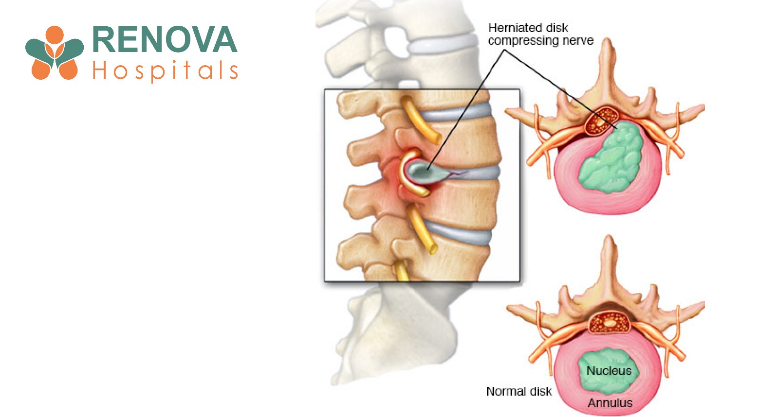 Laminectomy and Discectomy Relieve Nerve Compression and Restore Mobility