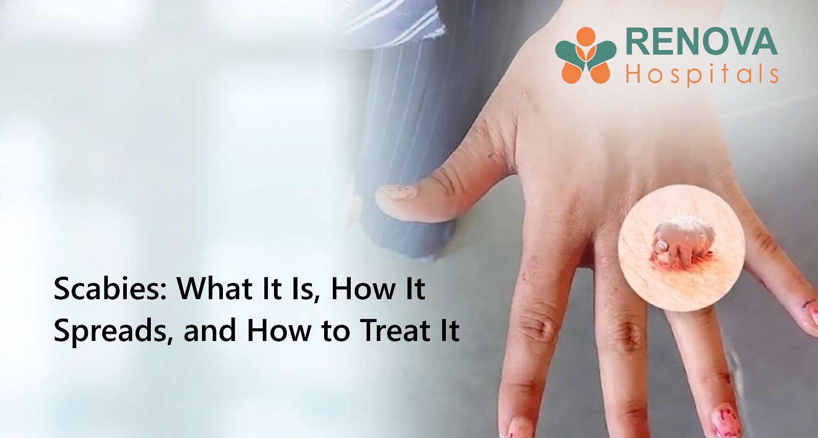 Scabies: Signs, Causes, Treatment and How to Prevent It