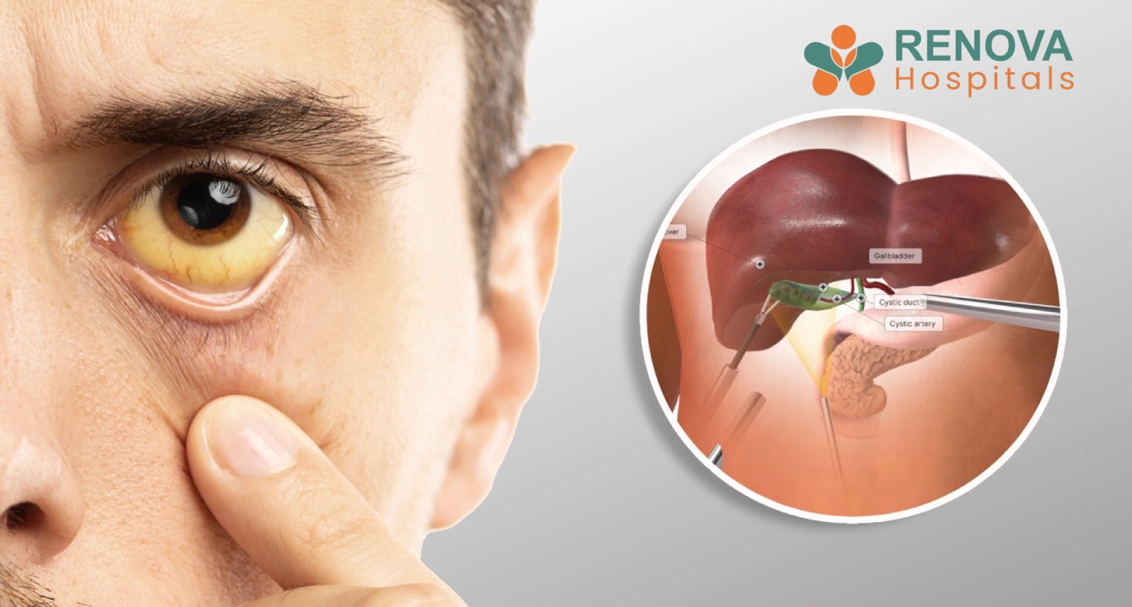 Yellowing of eyes due to jaundice, showing liver and bile duct blockage causing obstructive jaundice