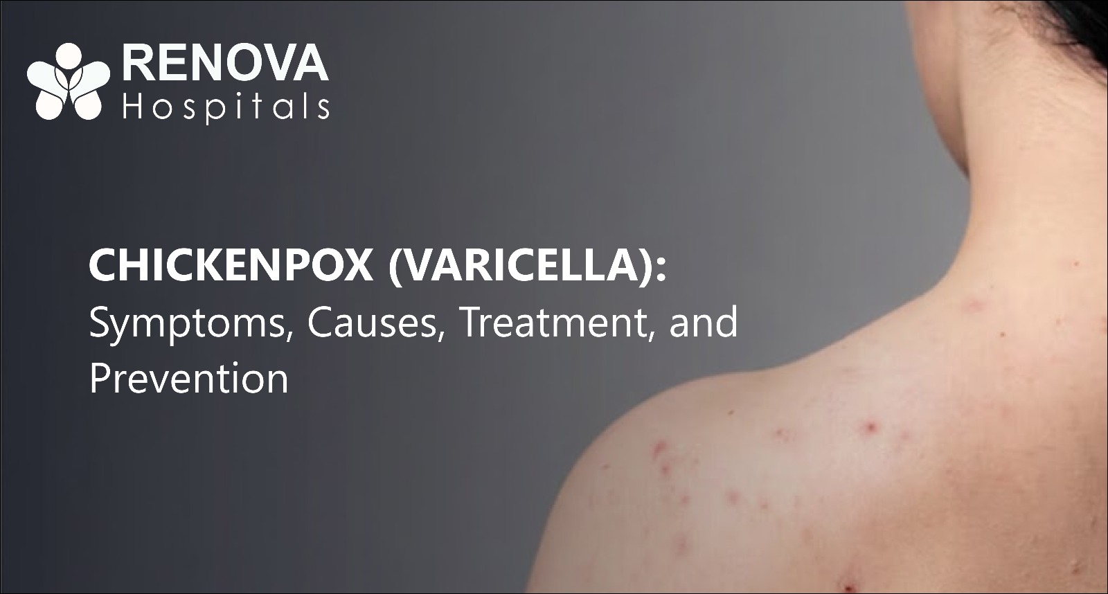 Chickenpox (Varicella)