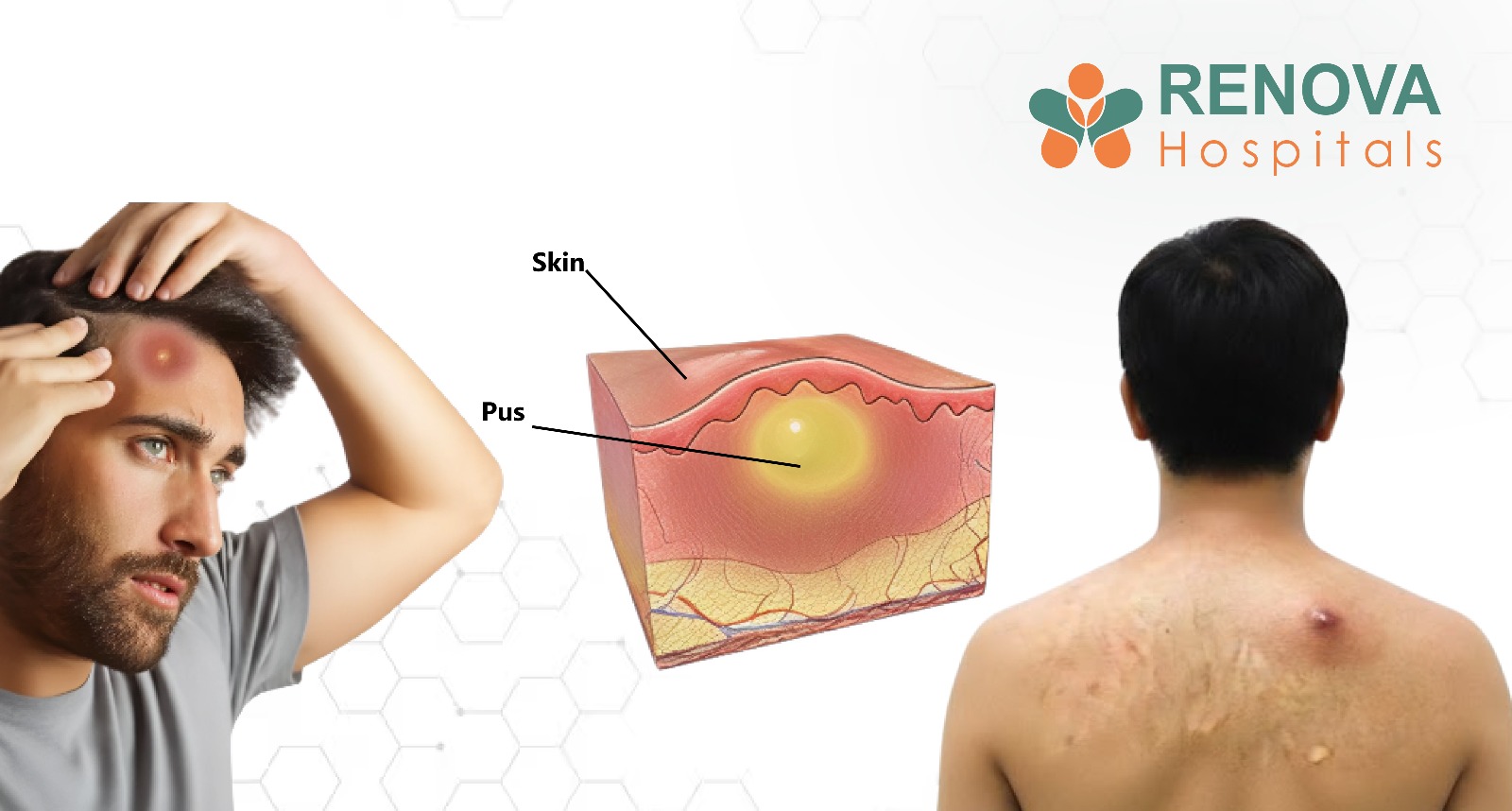 Skin vs Internal Abscess
