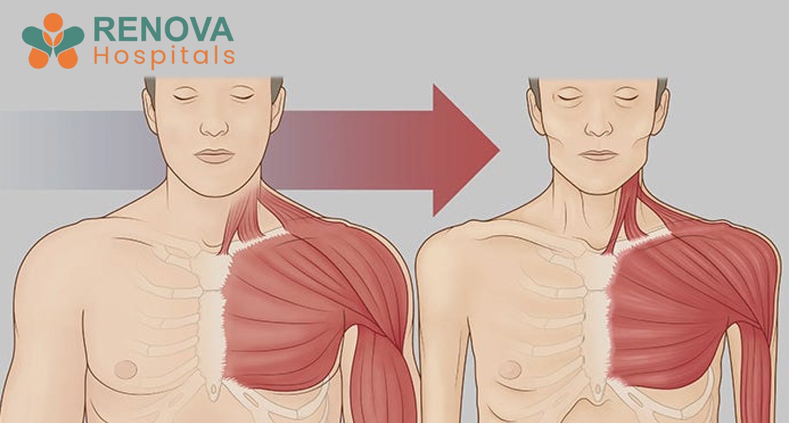 Medical illustration of cachexia affecting muscle and fat tissue
