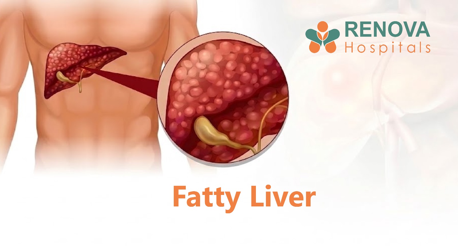 Fatty Liver and Liver Cancer Risk