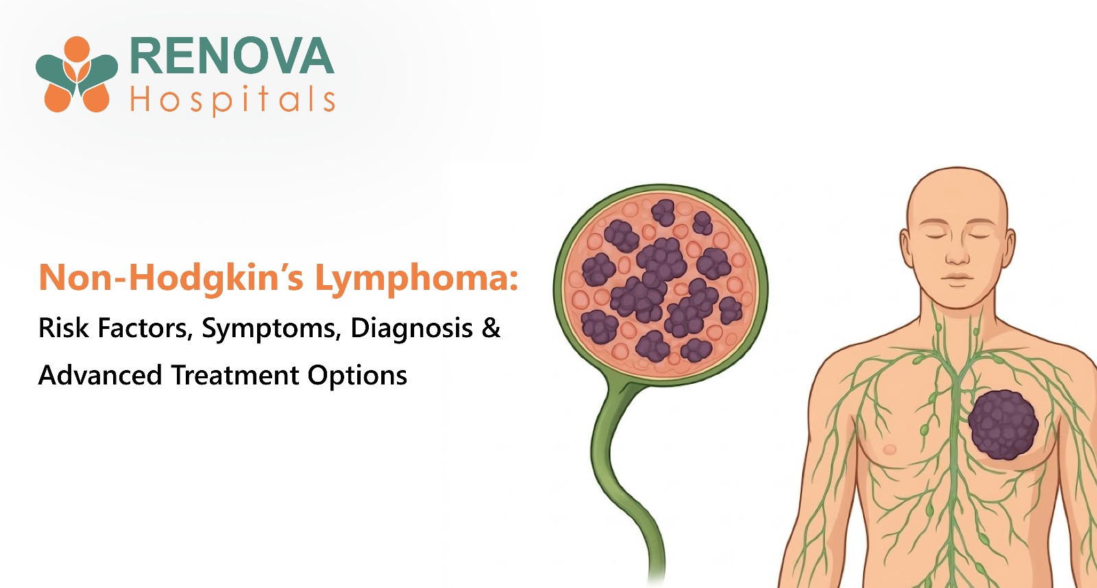 Early Detection and Advanced Treatment Improve Outcomes in Non-Hodgkin’s Lymphoma