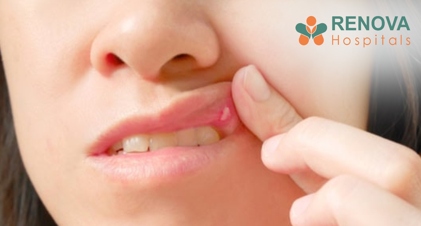 Mouth Ulcers: Why Do You Get Them Frequently?