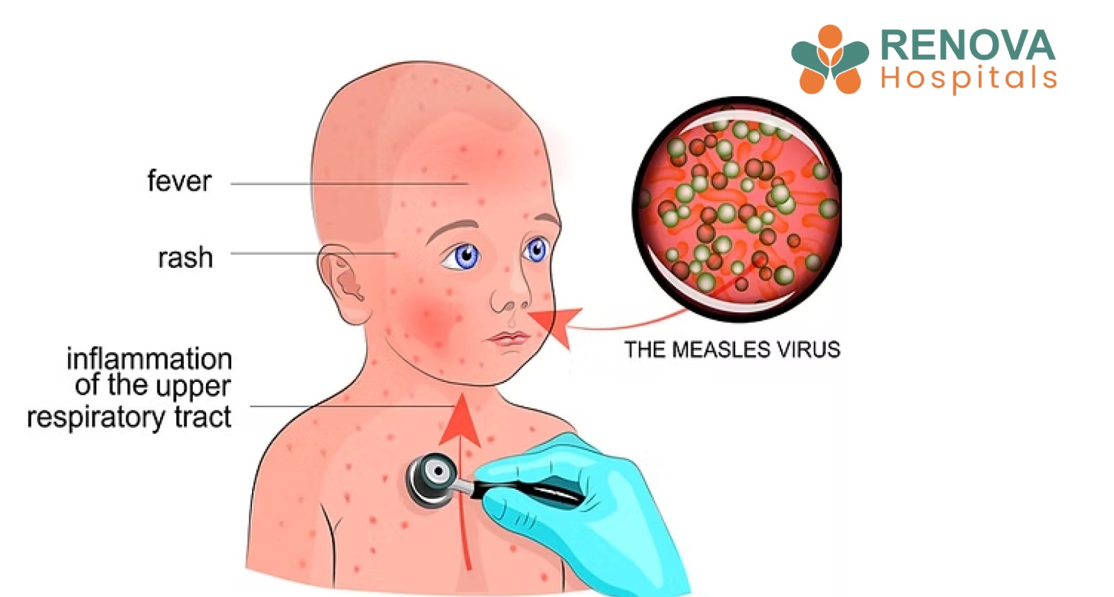 Kawasaki disease signs, symptoms, and cardiac complications.