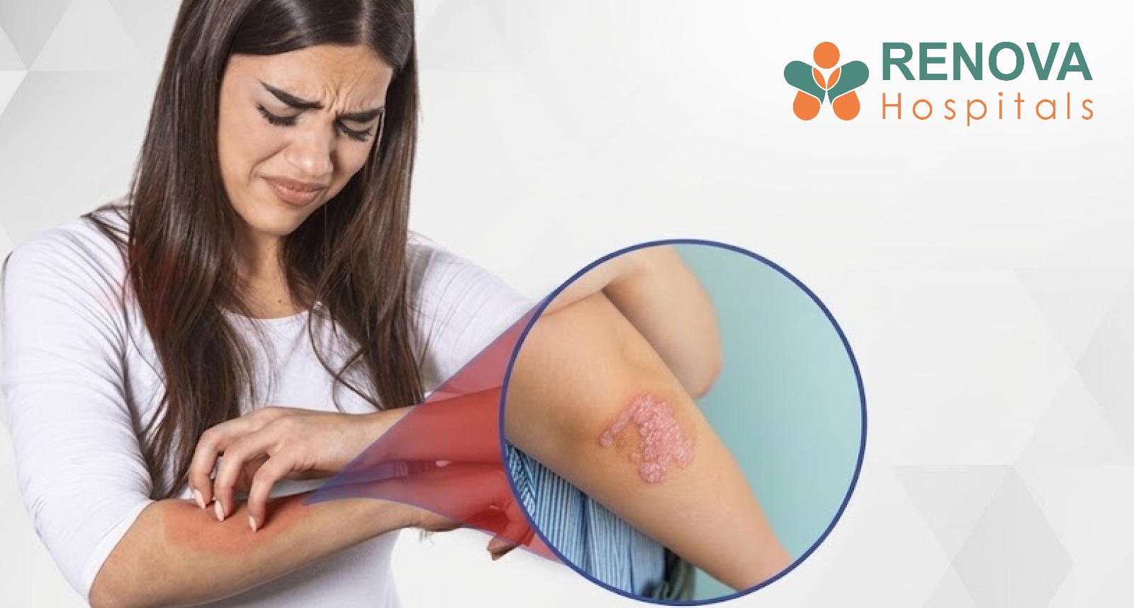 Psoriasis Flare-Ups: What Triggers Them and How You Can Prevent Them