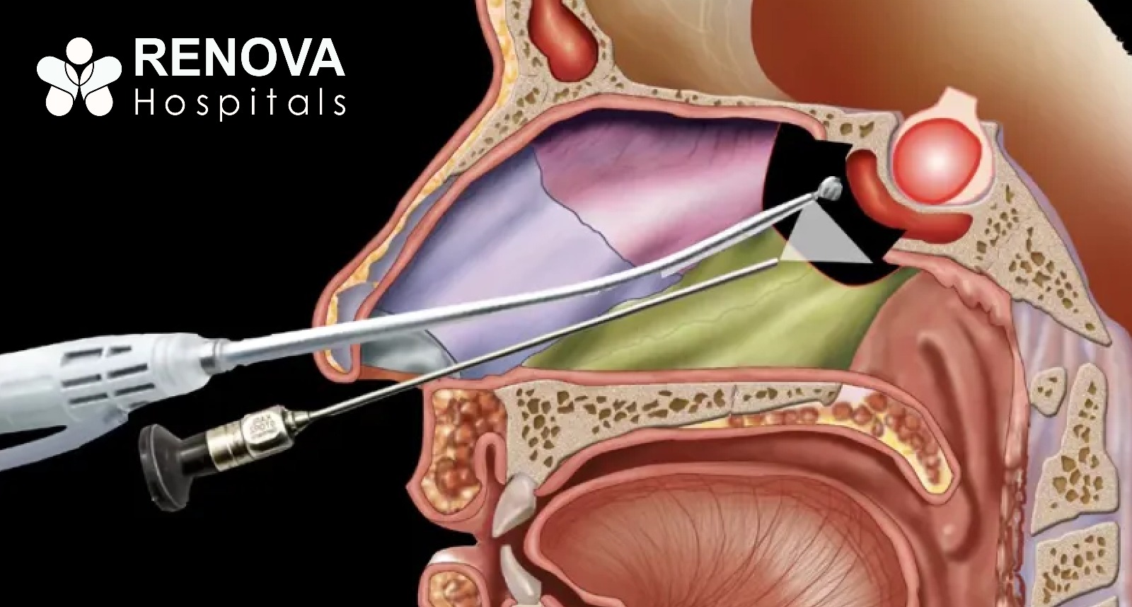 Endoscopic Pituitary Surgery Offers Precise Treatment Without External Incisions
