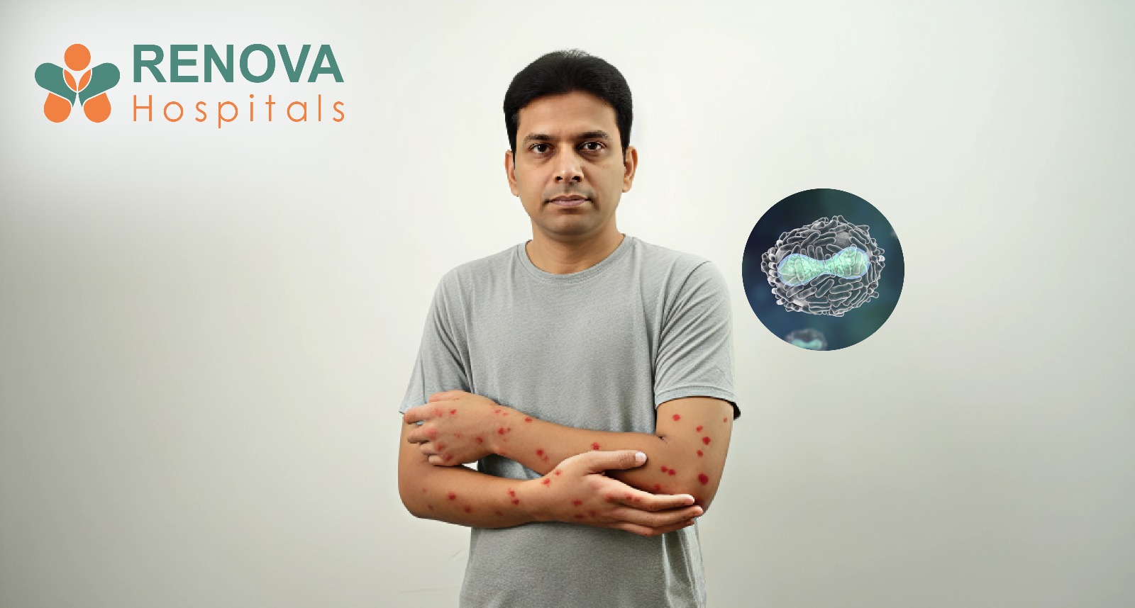 Vaccinia Virus Treatment at Renova Hospitals