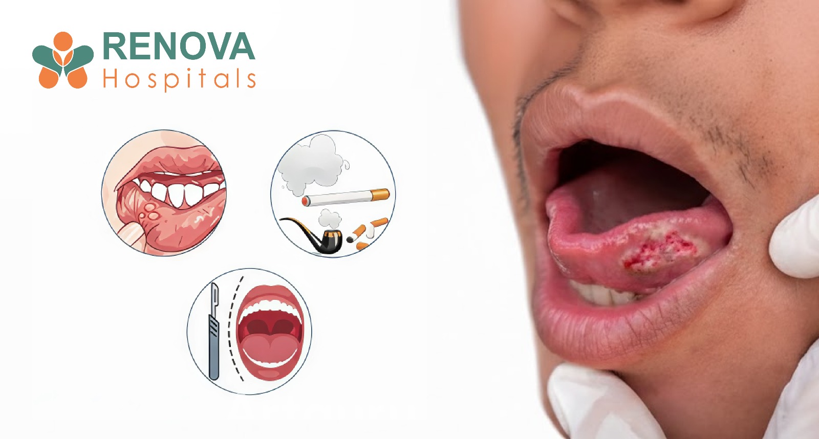 Oral Cancer in India: Causes, Early Signs, and Survival Rates