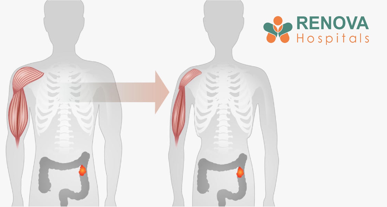 Cancer-Related Cachexia