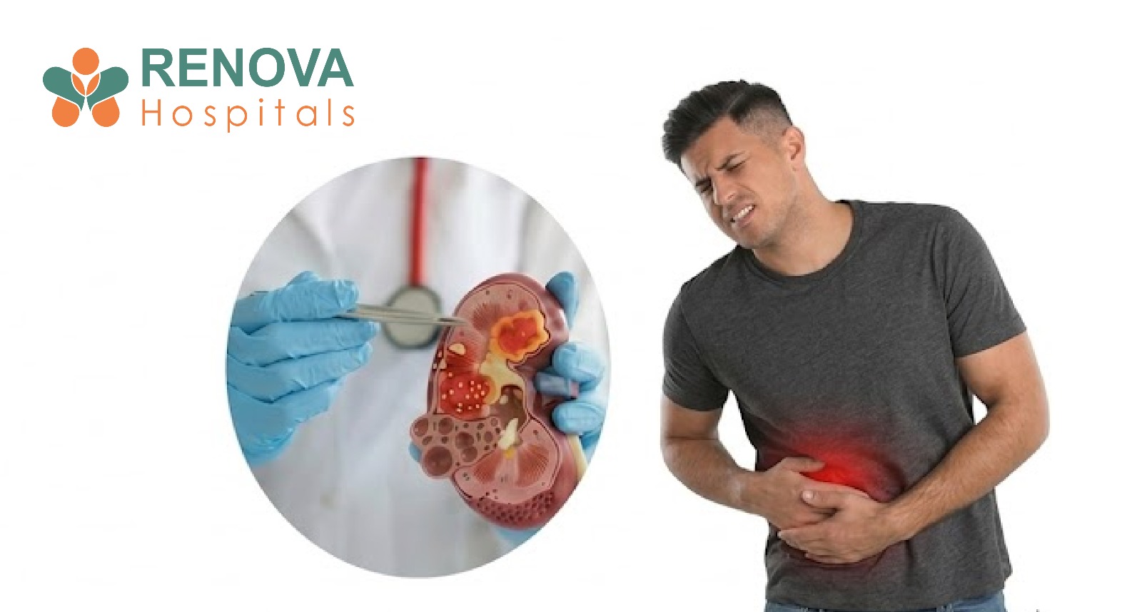 Kidney Cancer: Early Signs, Causes, and Treatment Options