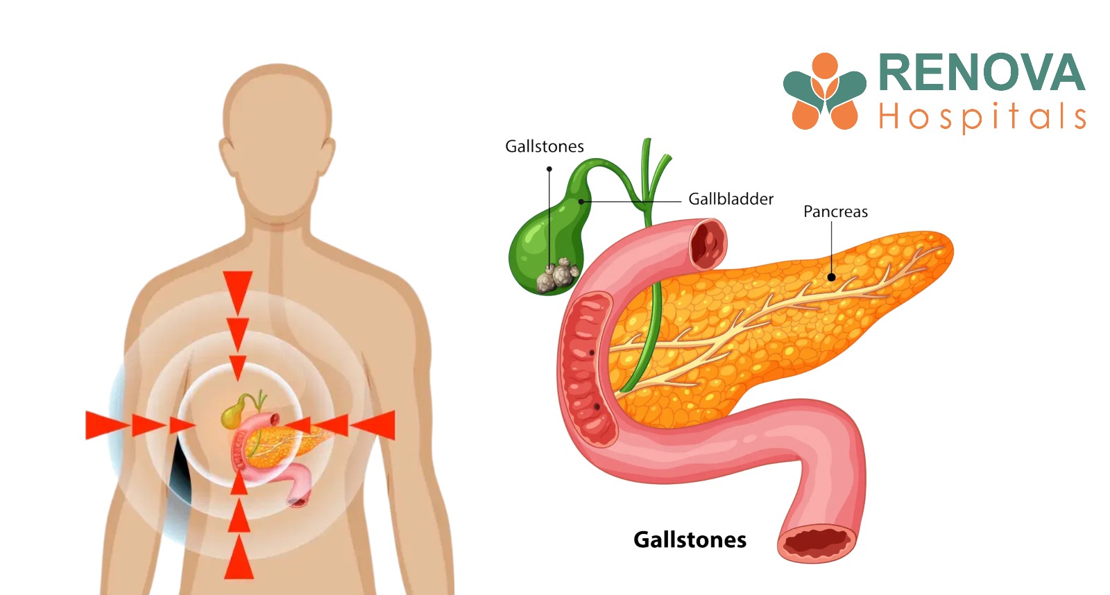 Gallstones and Pancreatic Anatomy