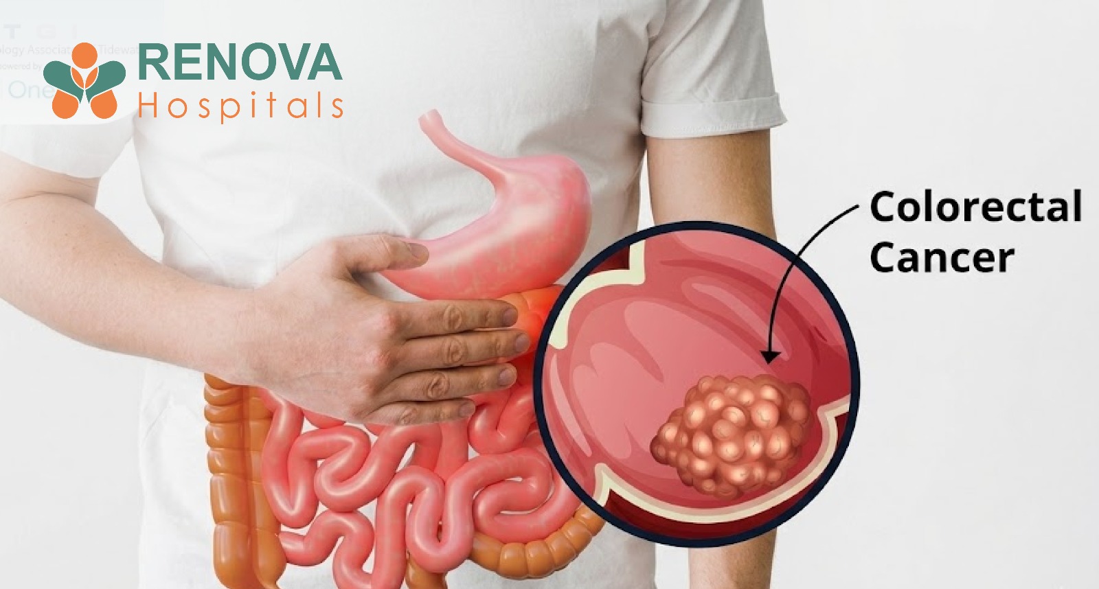 Colorectal Cancer Explained: Recognising the Signs and Lowering Your Risk