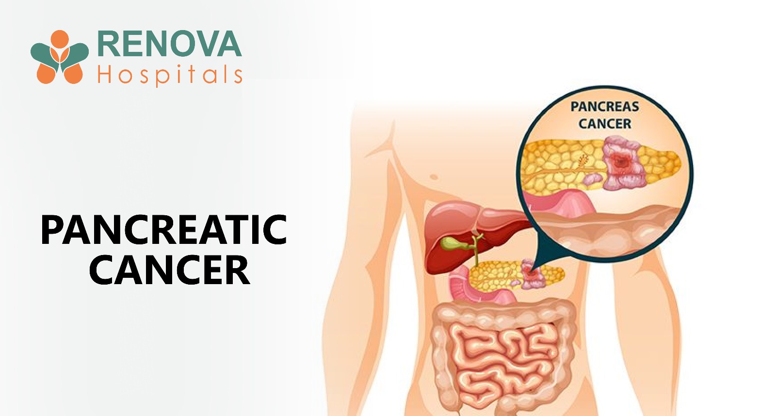 Pancreatic Cancer Treatment at Renova Hospitals