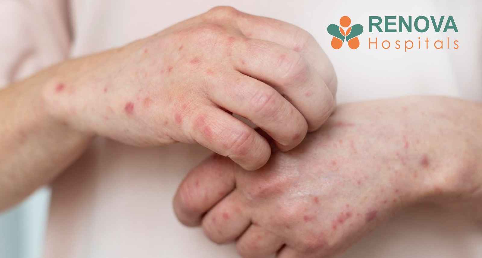 Scabies: Signs, Causes, Treatment and How to Prevent It
