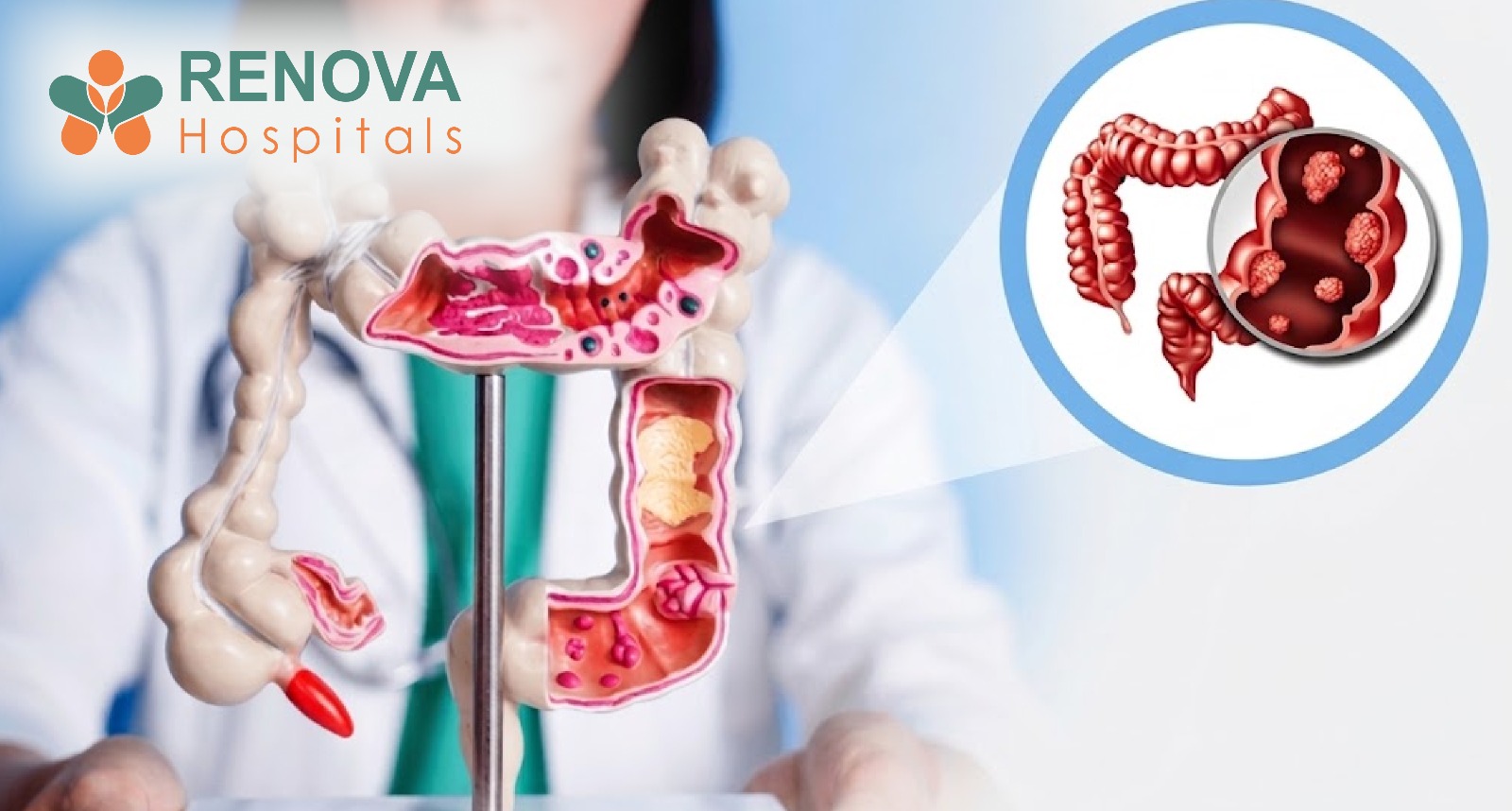 Early Detection of Colon Cancer Can Significantly Improve Survival Rates