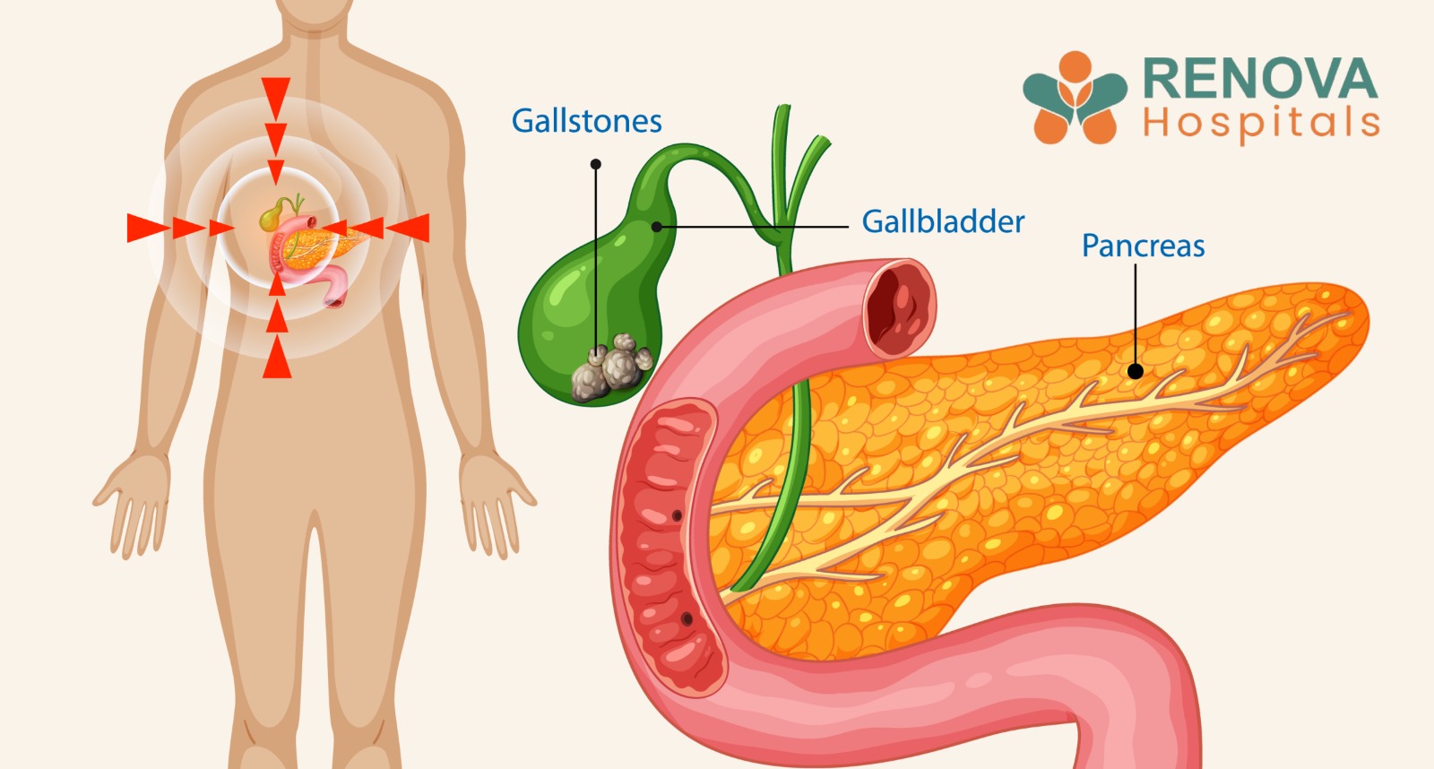 Gallstones Treatment at Renova Hospitals