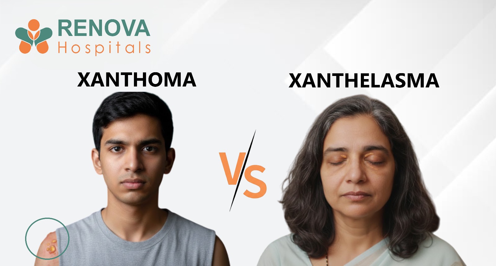Xanthoma vs Xanthelasma Treatment at Renova Hospitals