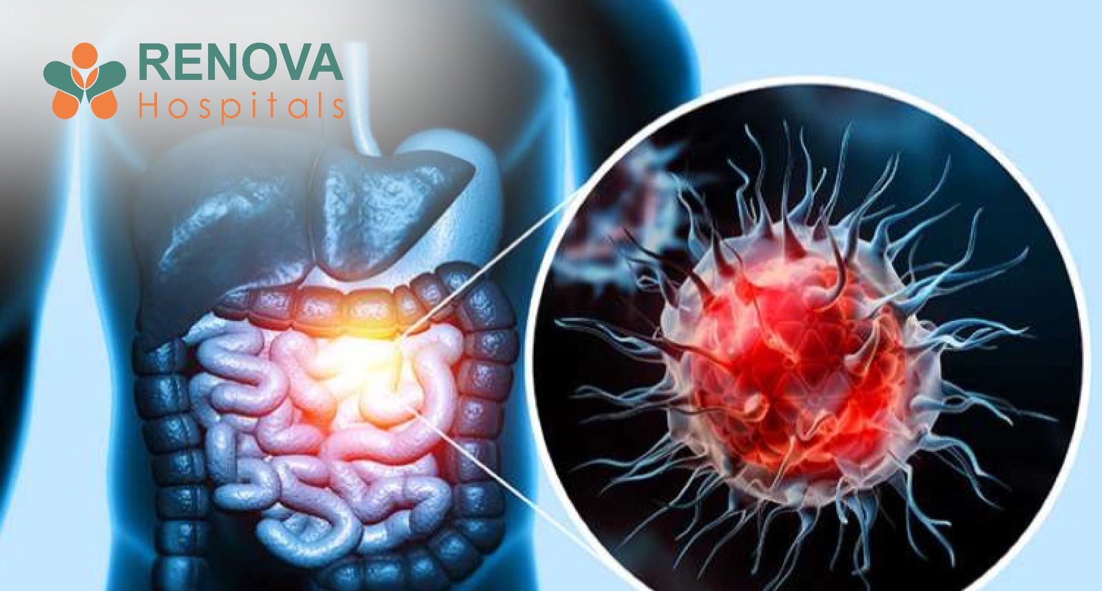 Colorectal Cancer Explained: Recognising the Signs and Lowering Your Risk