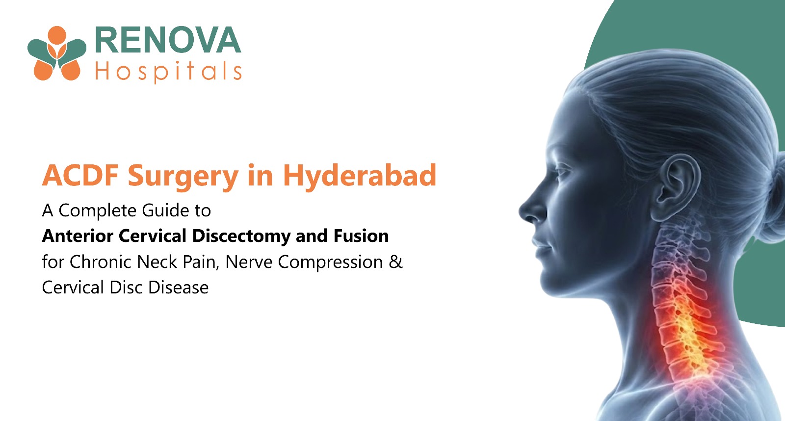 ACDF Surgery Relieves Cervical Nerve Compression and Chronic Neck Pain