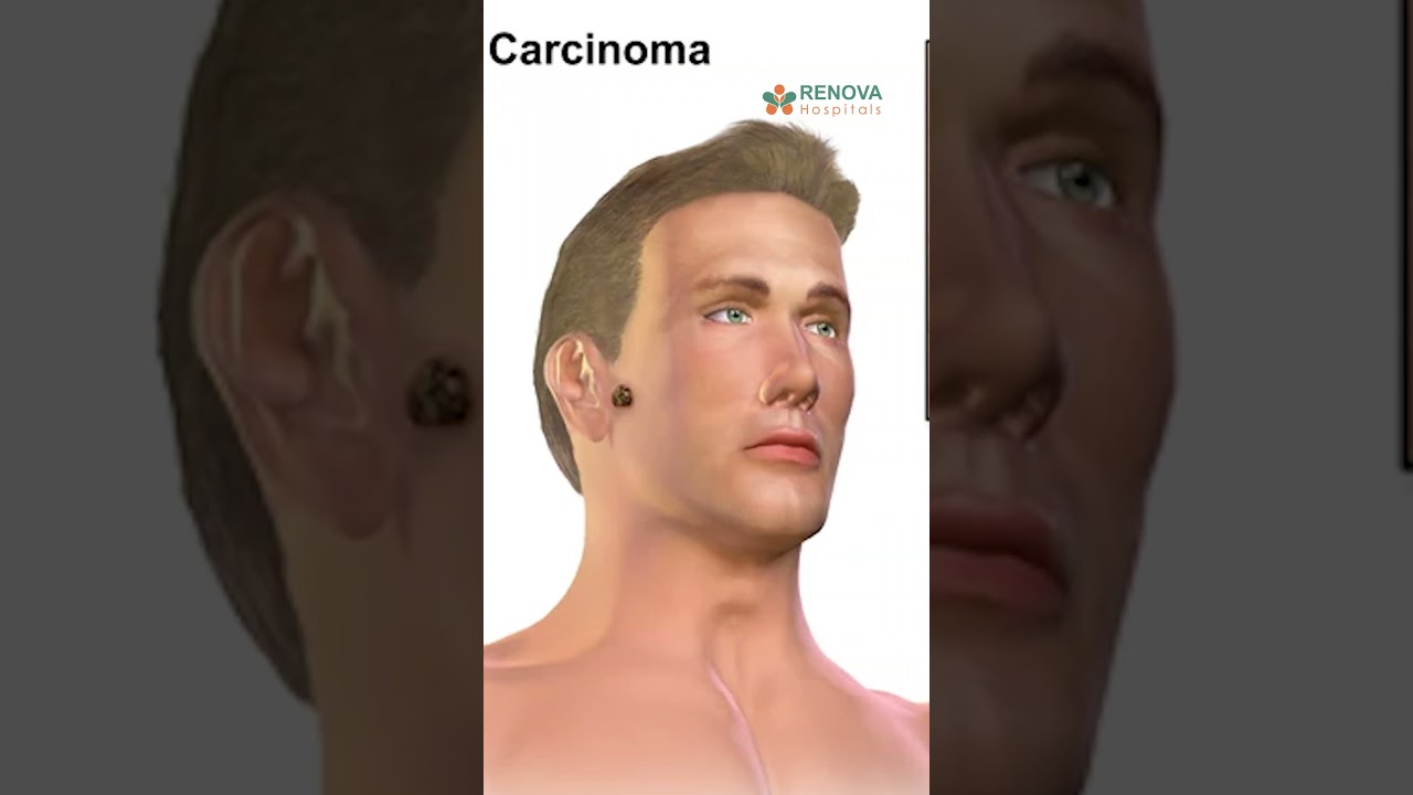 Skin Cancer Symptoms in Telugu