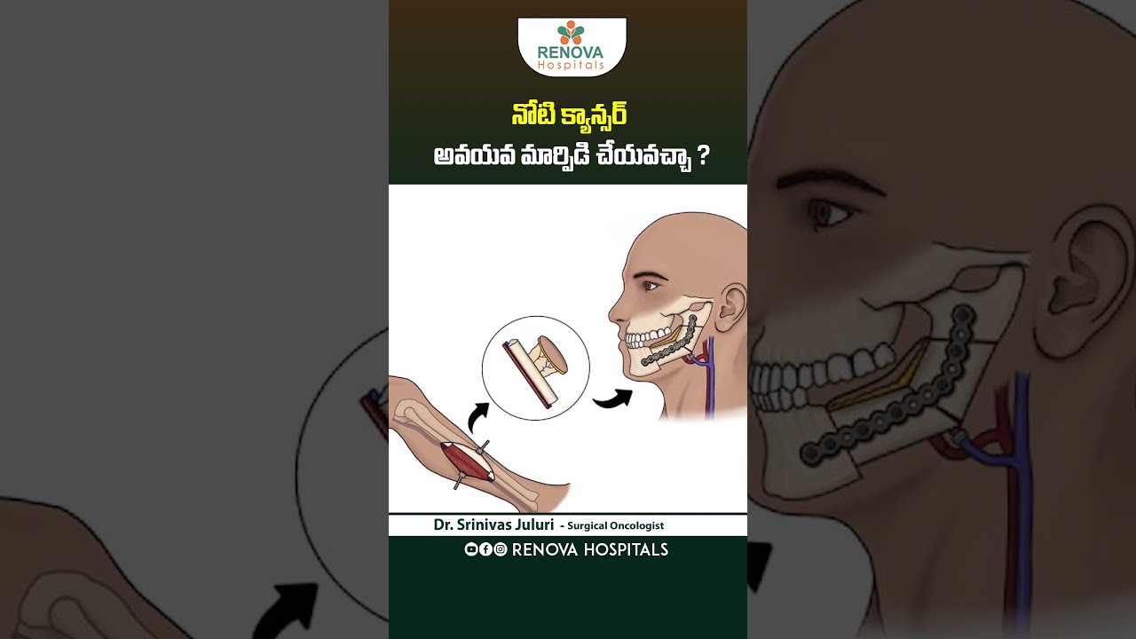Jaw Reconstruction Surgery for Oral Cancer || Reconstructive Surgery | Renova Hospitals || #shorts