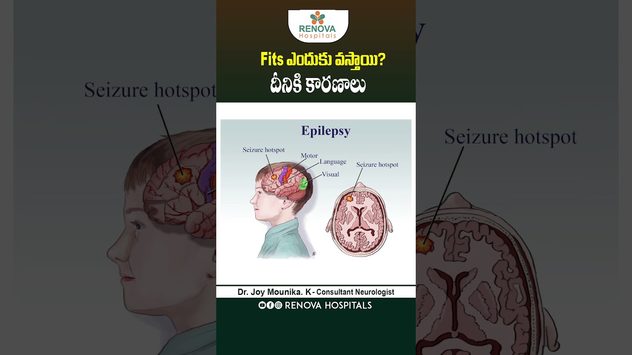 What Causes Epilepsy? | Common Causes of Fits in Telugu | Renova Hospitals | #shorts #fits