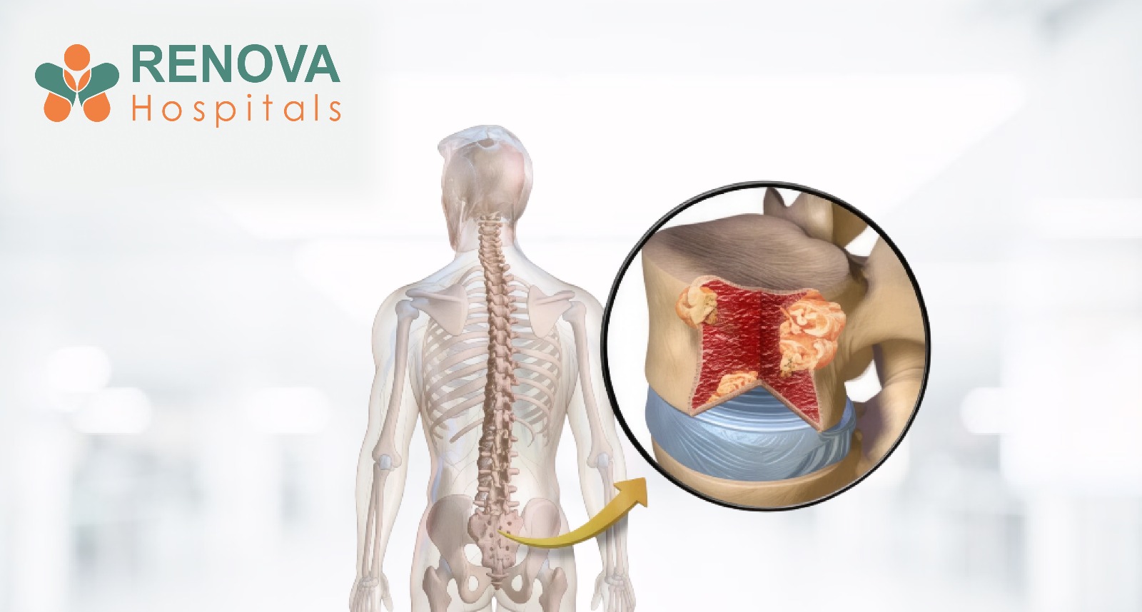 Multiple Myeloma Treatment at Renova Hospitals